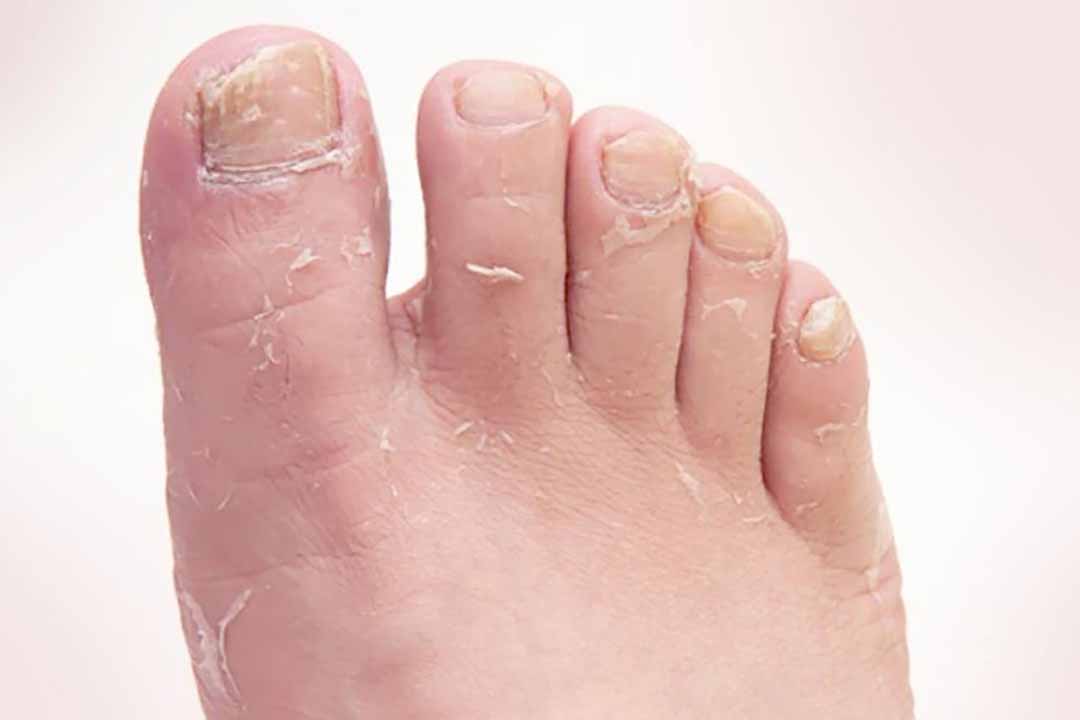 Dầu tràm Huế chống nấm bàn chân